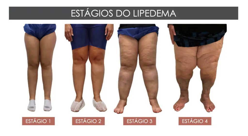 Lipedema: Guia Completo para Entender e Tratar a Condição